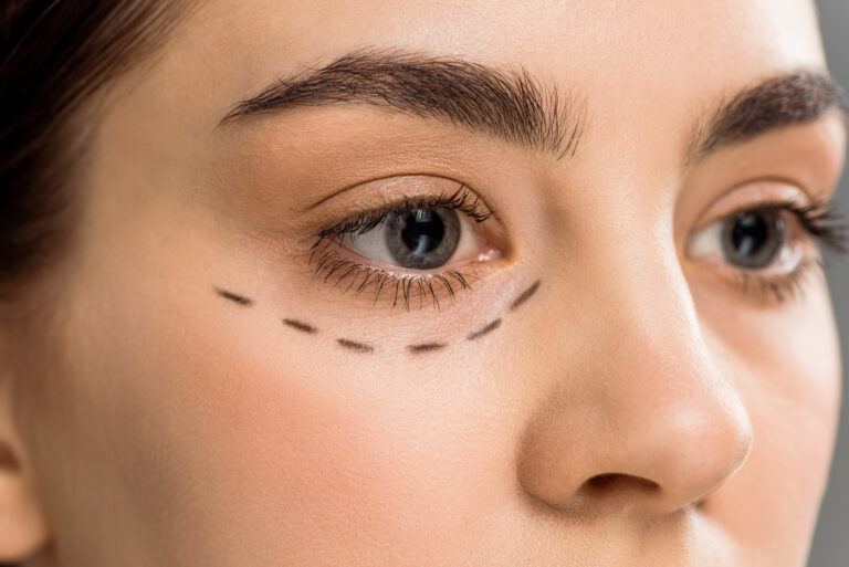 Blepharoplasty