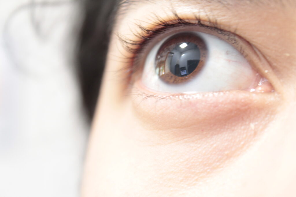 Eye Dilation | Ophthalmology & Visual Sciences