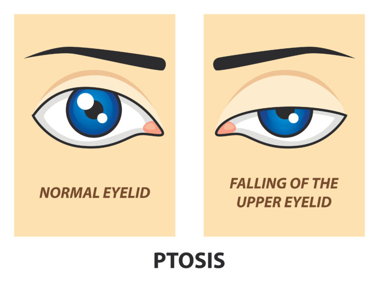 Ptosis