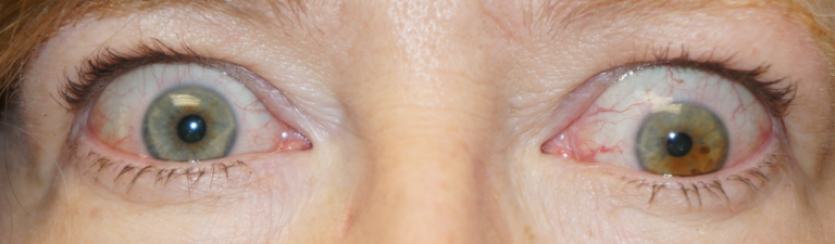 Thyroid Eye Disease