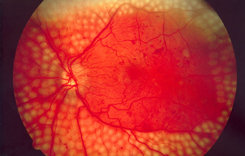 Diabetic Eye Disease