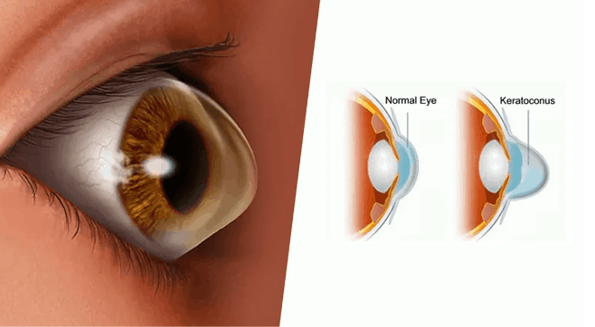 keratoconus