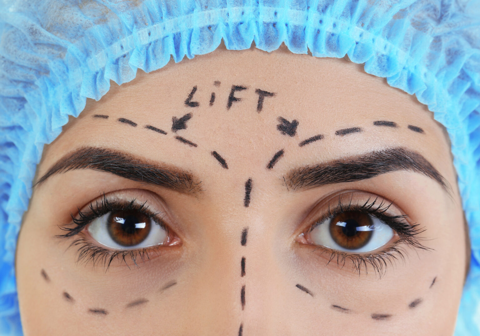 Endoscopic Brow Lift Ophthalmology And Visual Sciences 