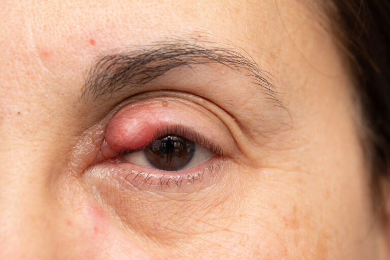 Eyelid Lesions