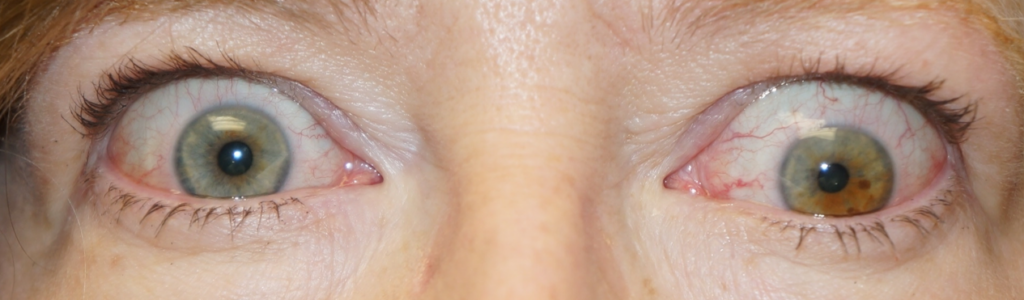 Thyroid Eye Disease | Ophthalmology & Visual Sciences