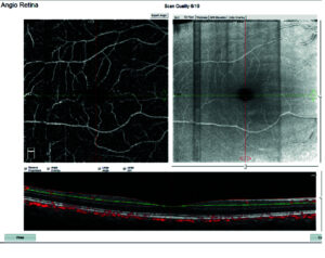 Optovue OCTA image of macula with superficial retinal capillary plexus overlay.