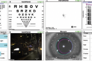 Treatment Strategies for Vision Loss Due to Thygeson Superficial Punctate Keratitis