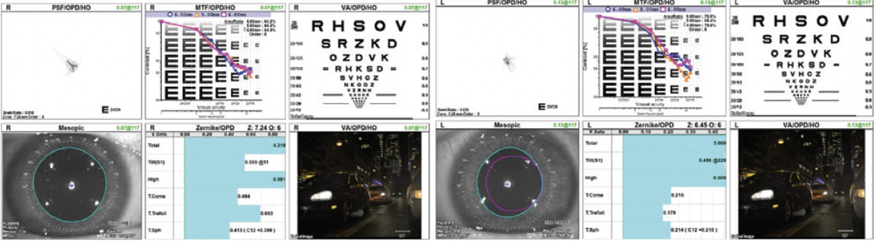 Treatment Strategies for Vision Loss Due to Thygeson Superficial ...